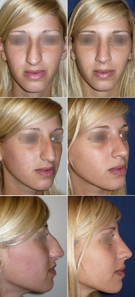 Rinoplastia Estética - Dra. María Fernanda Valotta